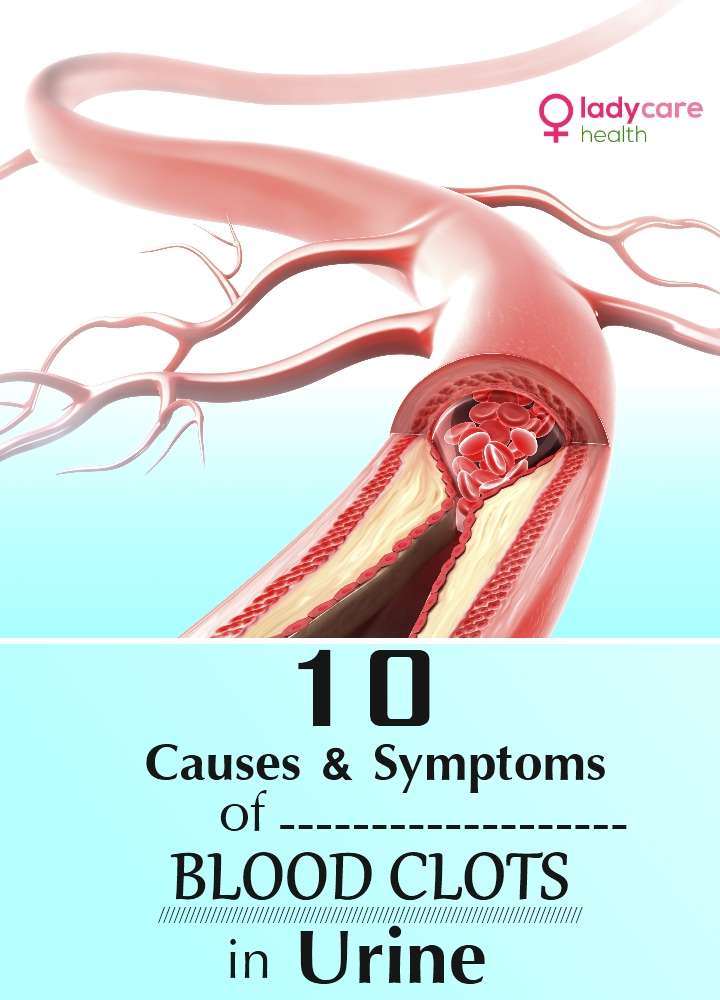 10 Causes And Symptoms Of Blood Clots In Urine
