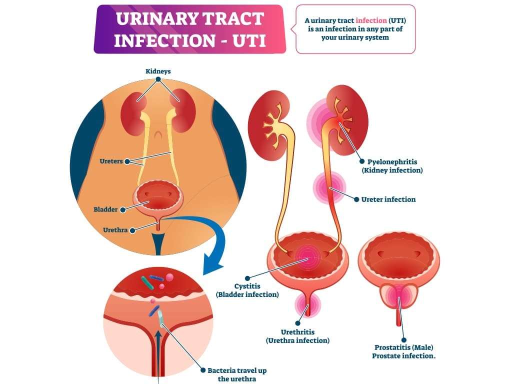 10 Home remedies for Urinary Tract Infection