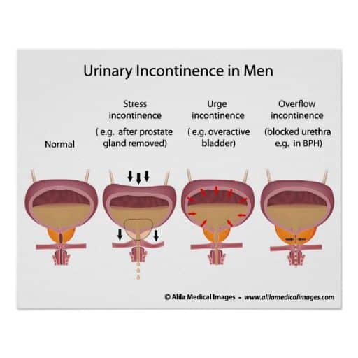 21 best Urinary Incontinence images on Pinterest