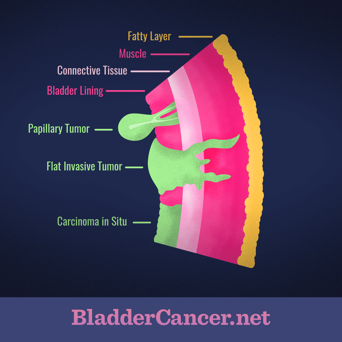 22+ Small Cell Carcinoma Bladder Prognosis Pics