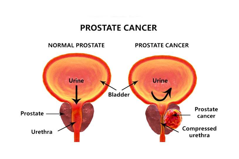 3 of the Most Common Prostate Conditions and their causes