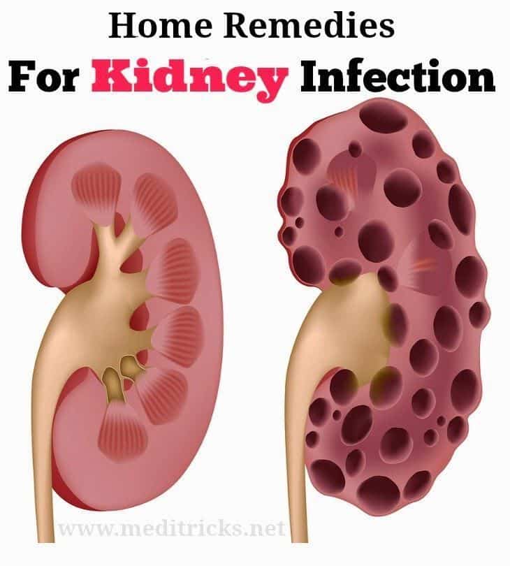40 best kidney stones images on Pinterest