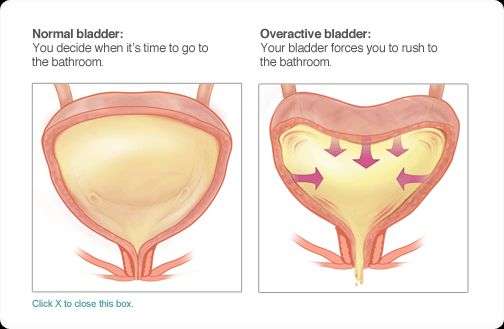 48 best images about Overactive Bladder on Pinterest