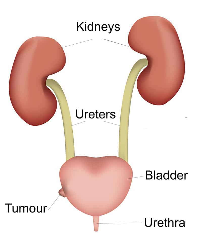 49+ What Does Bladder Cancer Do Pictures