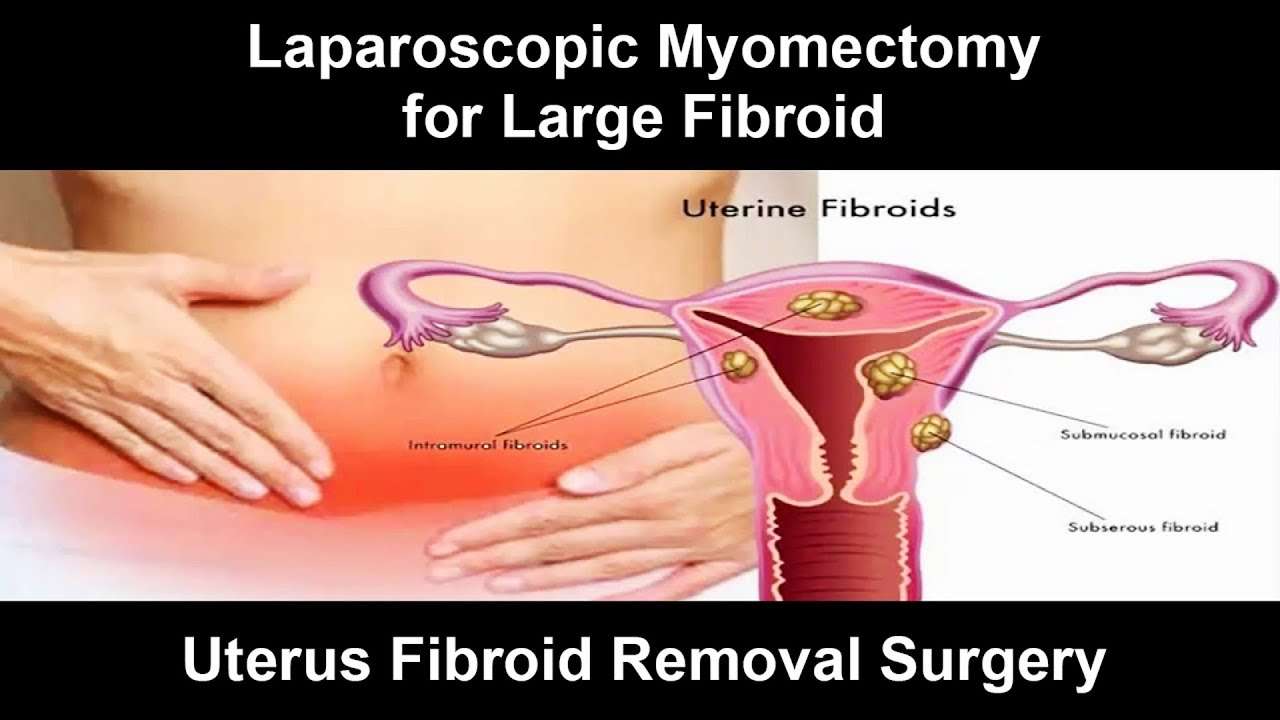 9 Cm Fibroid Removal