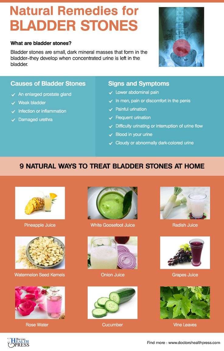9 Natural Remedies for Bladder Stones
