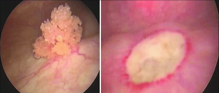 (a) Cystoscopy image showing the fronded bladder tumor  (b ...