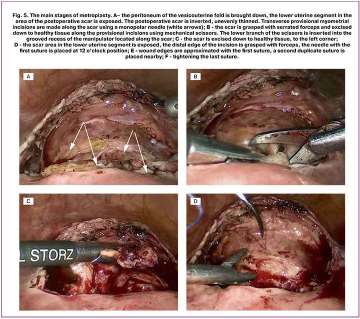 A new method for surgical treatment of uterine scar insuffisiency after ...