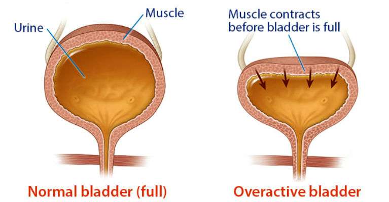 Acupuncture for overactive bladder