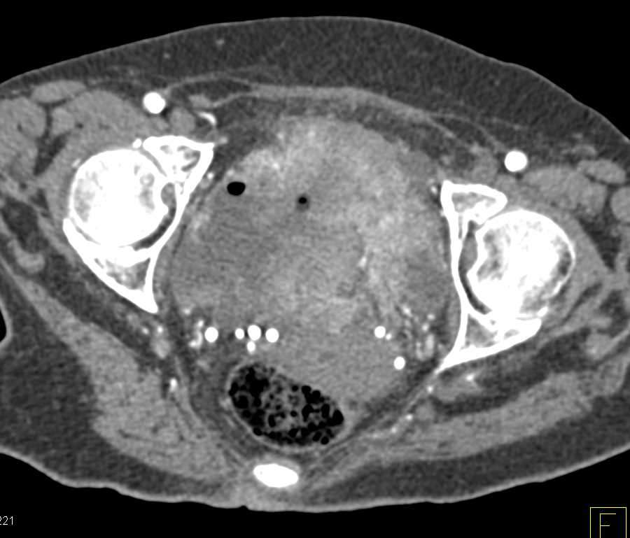 Aggressive Bladder Cancer with Extension Through the Bladder Wall ...