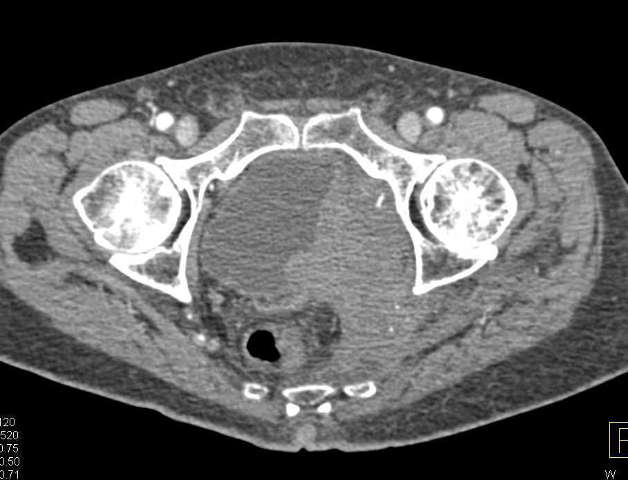 Aggressive Bladder Cancer with Pelvic Side Wall Invasion ...
