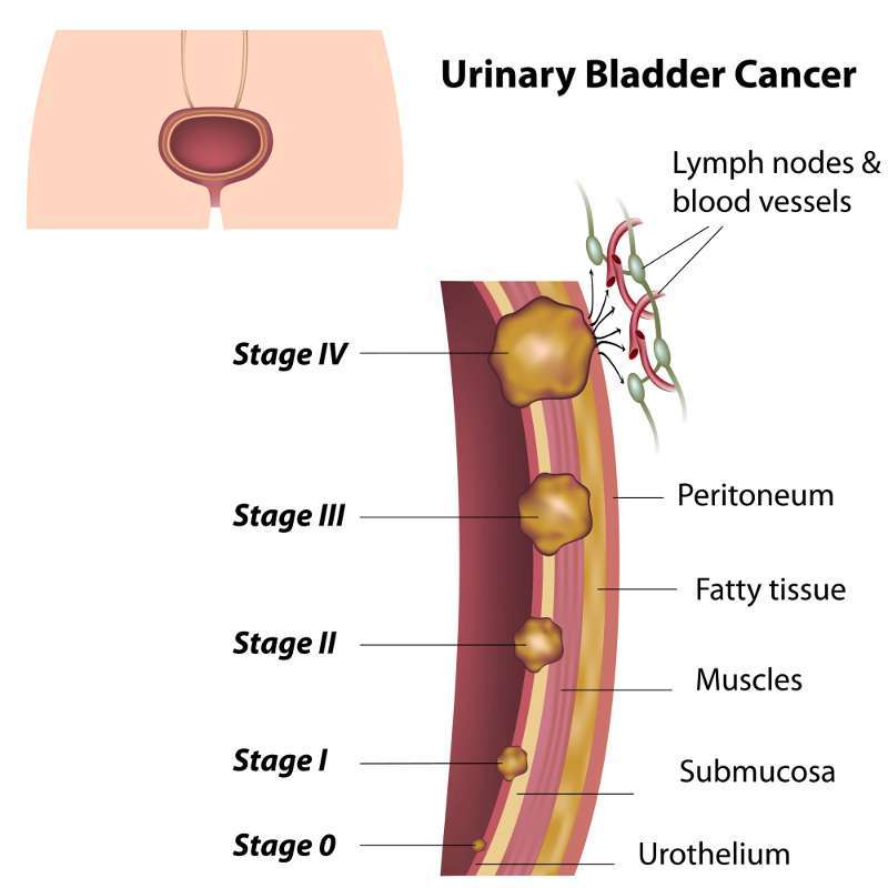 All About Bladder Cancer: For Patients and their Families