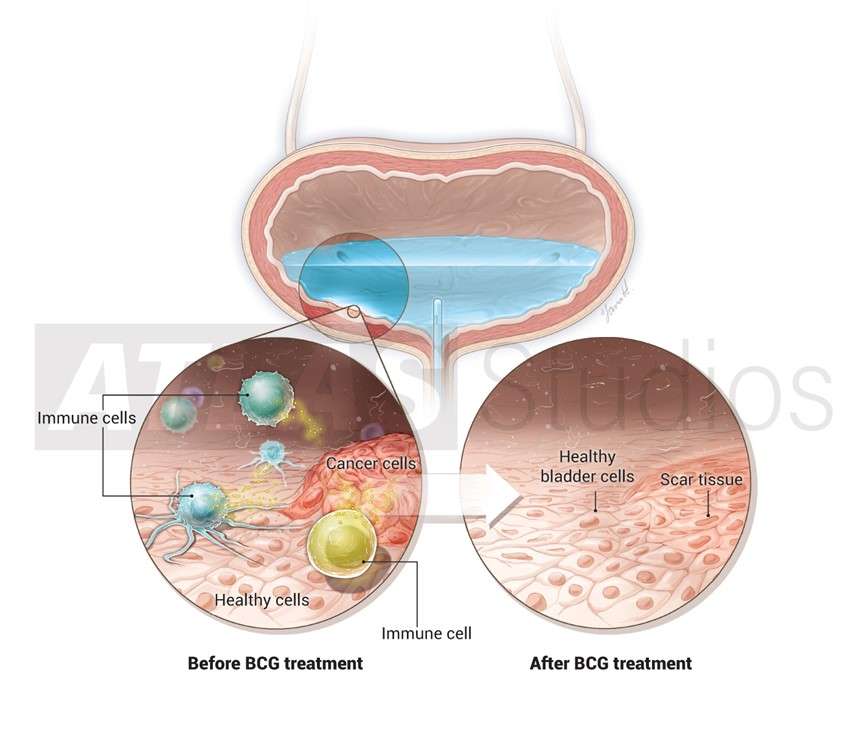 BCG Treatment for Bladder Cancer Illustration by ATLAS Studios ...