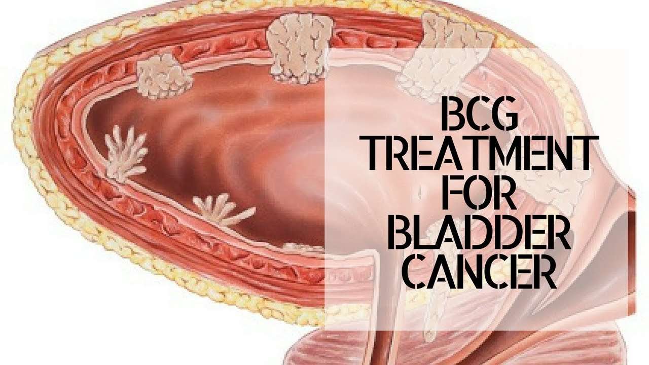 BCG TREATMENT FOR BLADDER CANCER