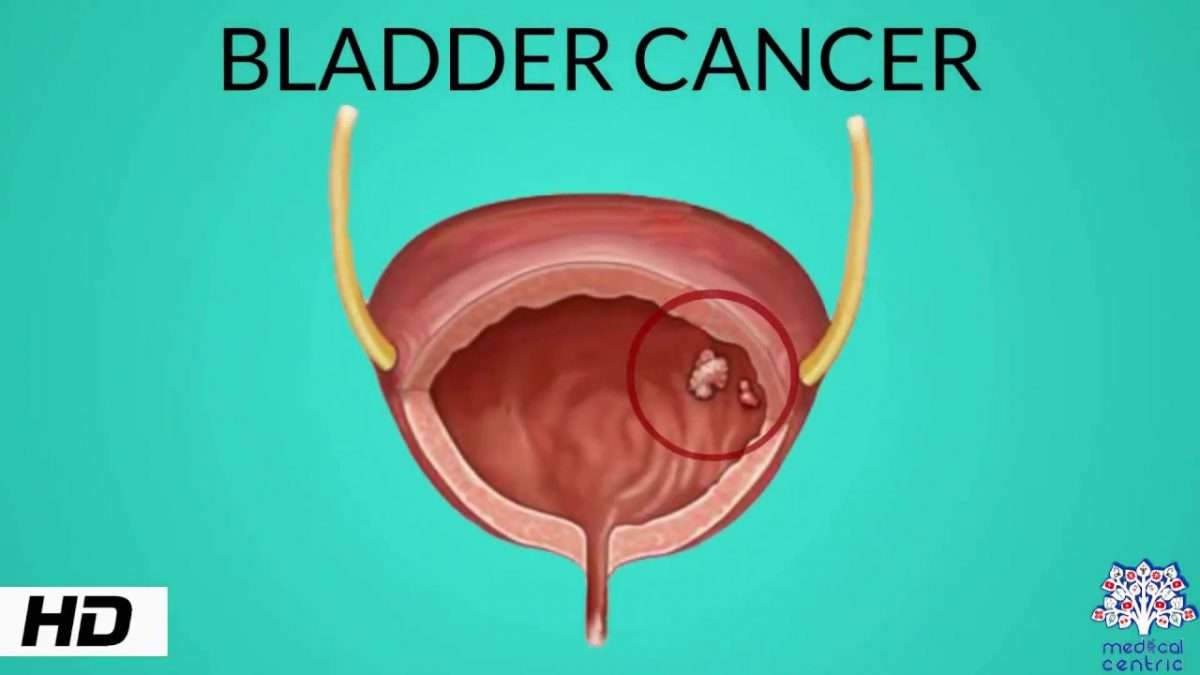 Bladder Cancer, Causes, Signs and Symptoms, Diagnosis and Treatment.