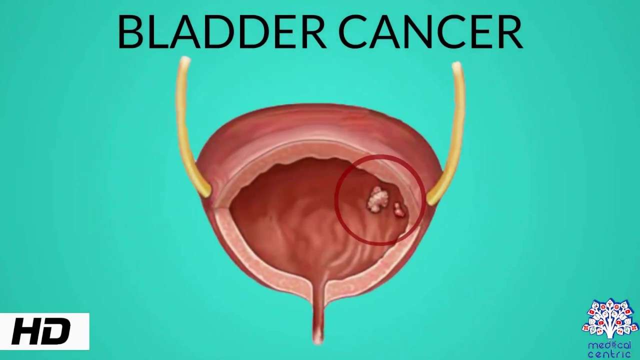 Bladder Cancer, Causes, Signs and Symptoms, Diagnosis and ...