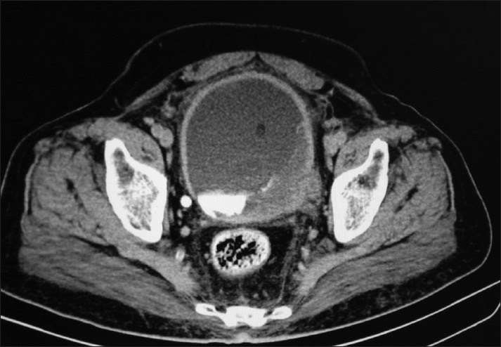 Bladder Cancer Ct Scan With Contrast