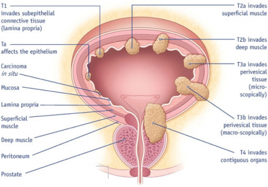 Bladder Cancer has an Unusual Potential Cure: The Common ...