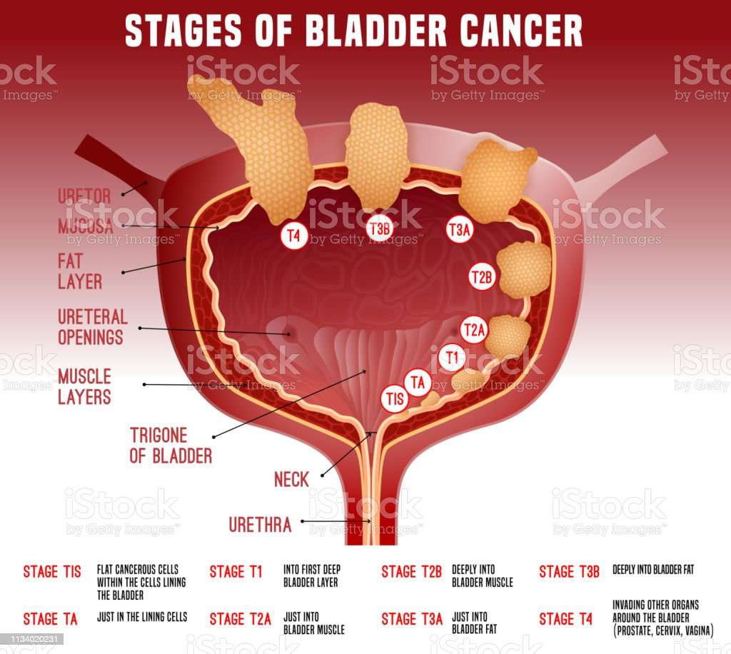 Bladder Cancer Image Stock Illustration