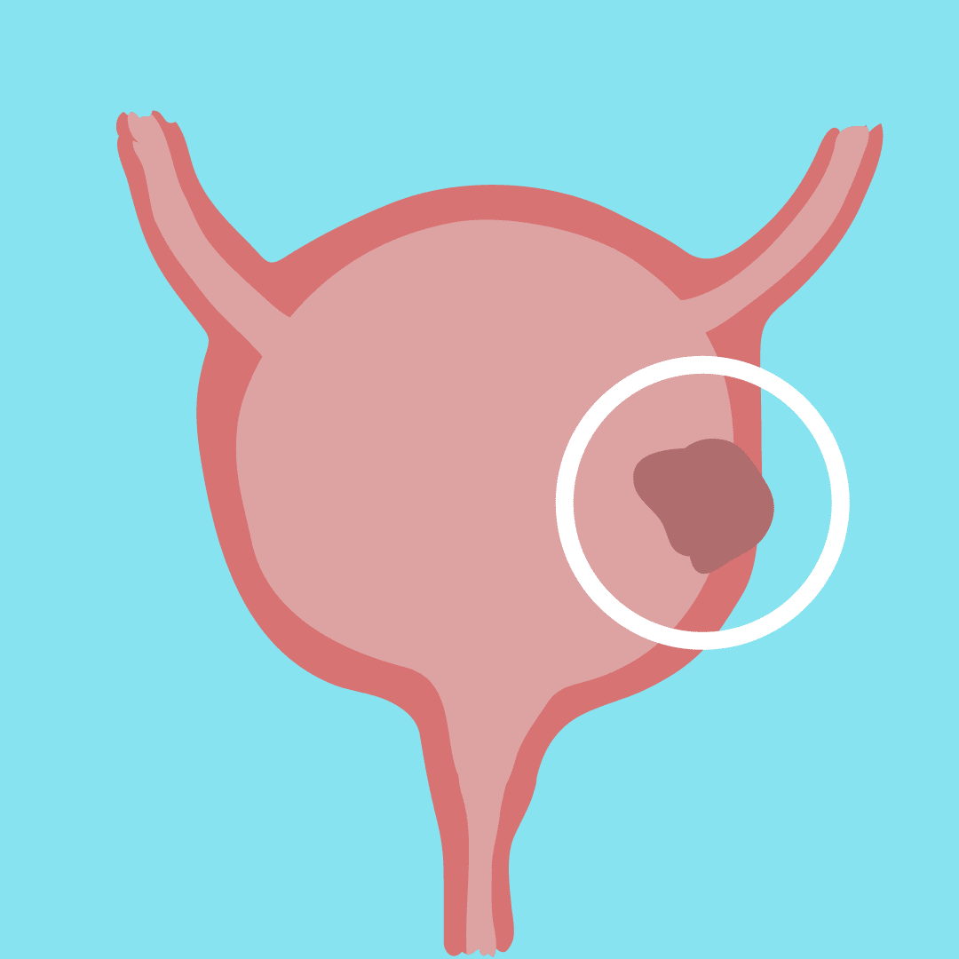 Bladder Cancer: Overview and More