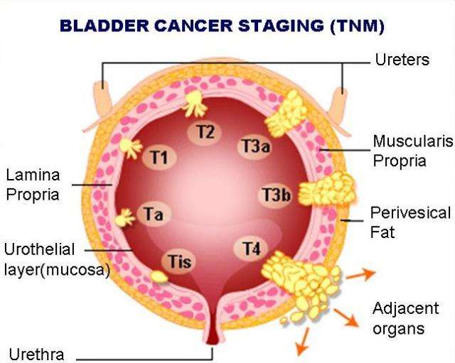 Bladder Cancer sign and symptoms