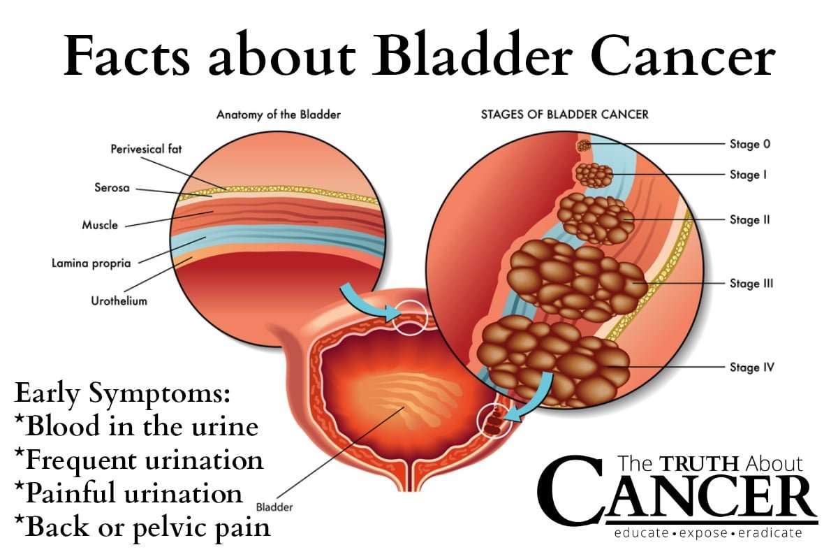 Bladder Cancer  Signs, Symptoms And Causes
