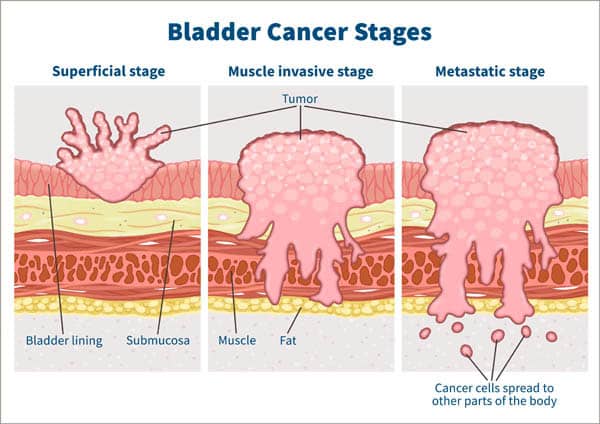 Bladder Cancer Survival: The Importance of Early Detection