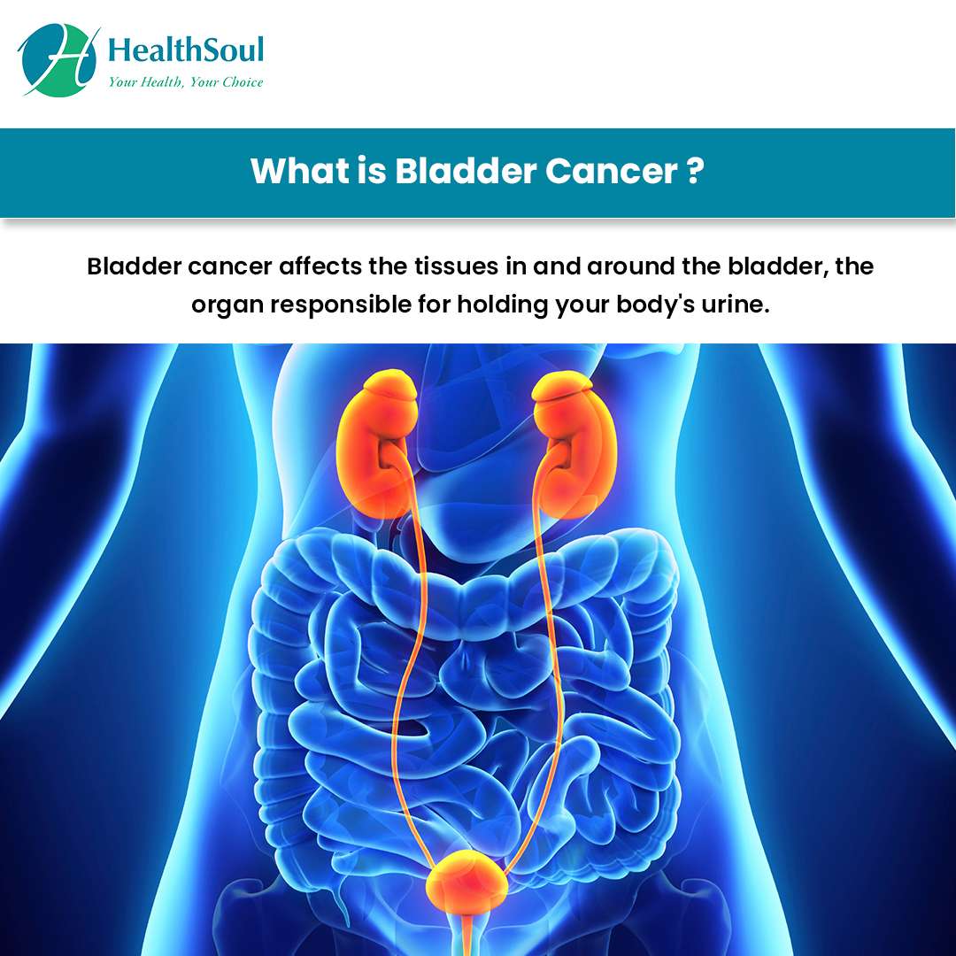 Bladder Cancer: Symptoms and Treatment  Healthsoul