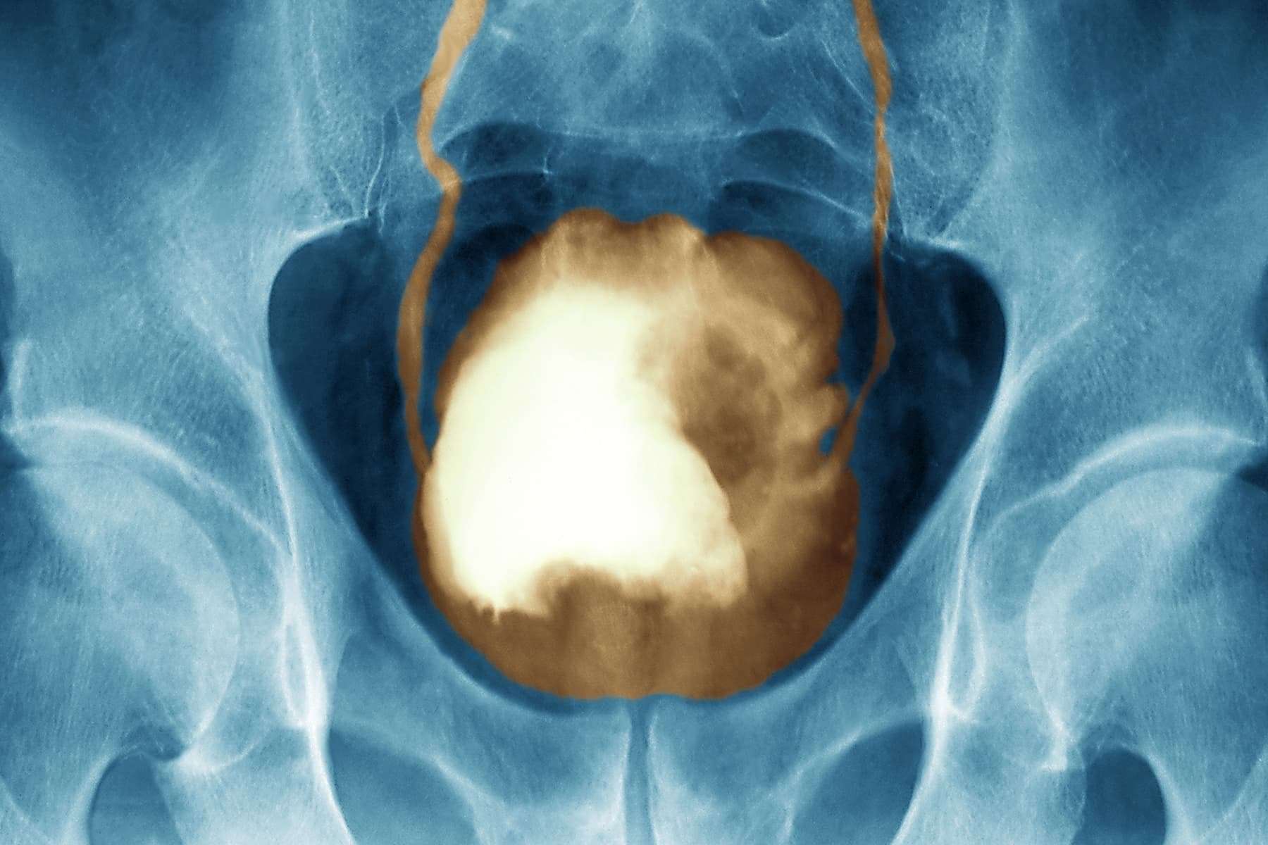 Bladder Cancer Symptoms Pictures: Warning Signs, Treatments, Survival Rates