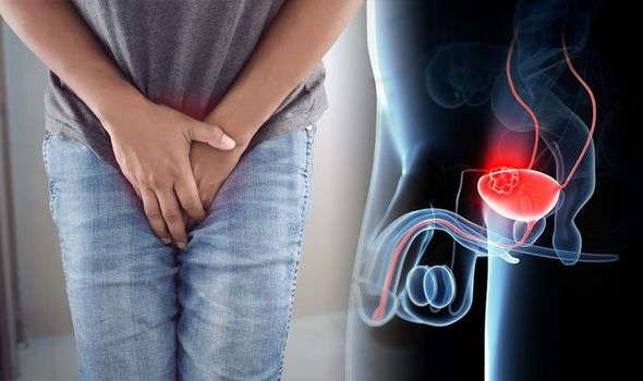 Bladder cancer symptoms: The most overlooked sign of the disease you ...