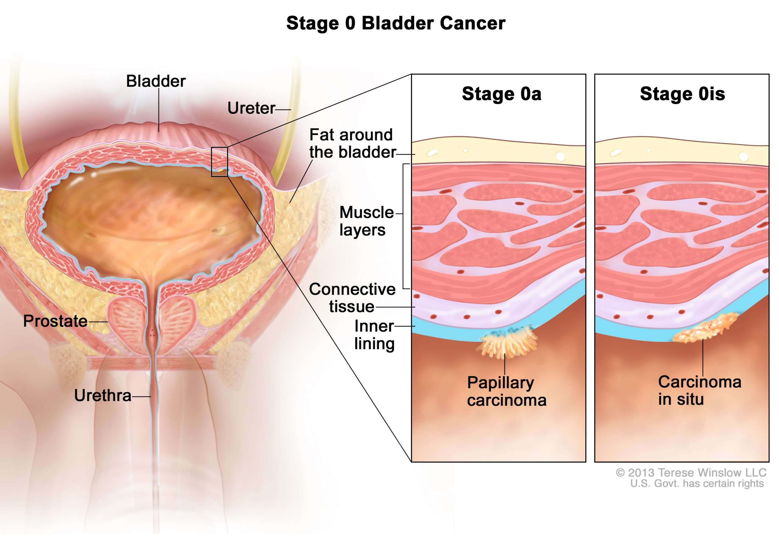 Bladder Cancer Treatment (PDQ®)