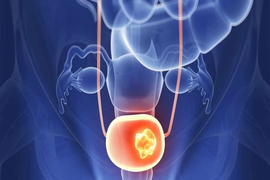 Bladder Cancer Treatment Treatment &  Cost Guide