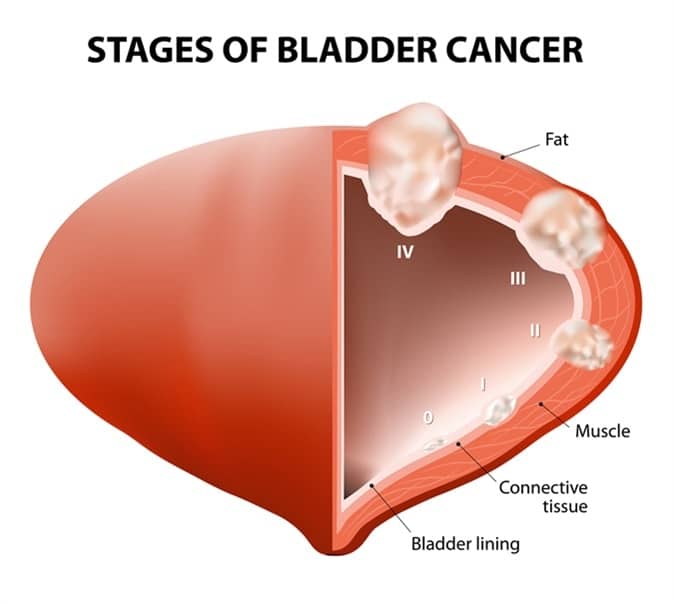 Bladder Cancer Types