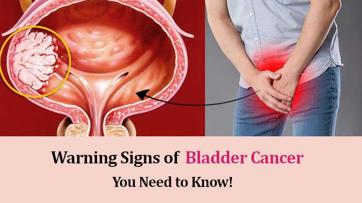 Bladder Cancer Warning Signs and Symptoms You Need to Know!