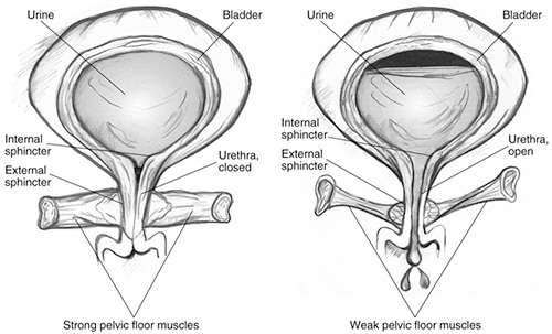 Bladder Control Problems in Women (Urinary Incontinence ...