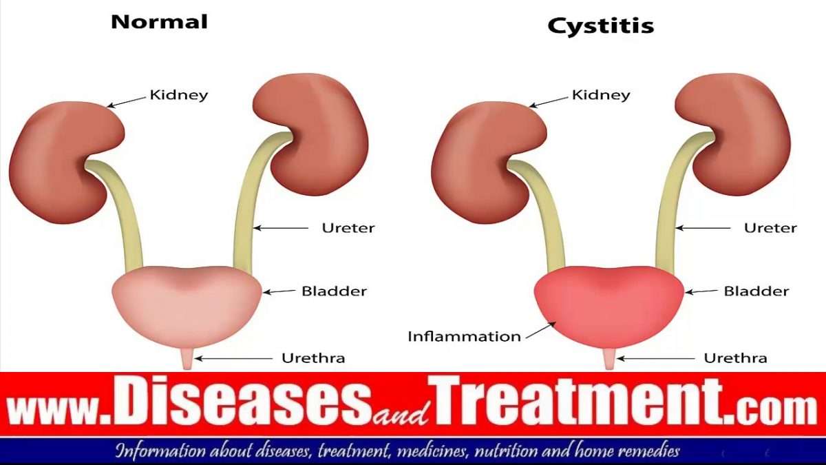 Bladder infection (cystitis) : Causes, Symptoms, Diagnosis, Treatment ...