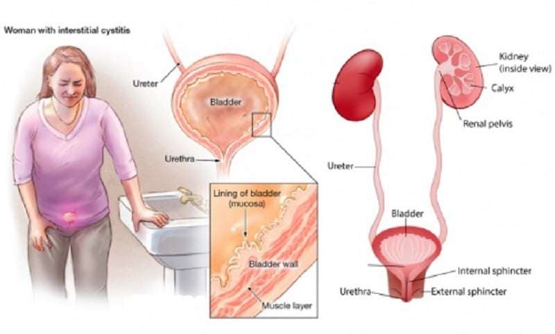 Bladder Infection Home Remedies : Human N Health