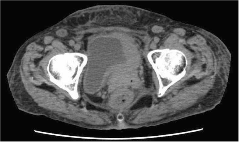 Bladder metastasis from primary breast cancer: a case report