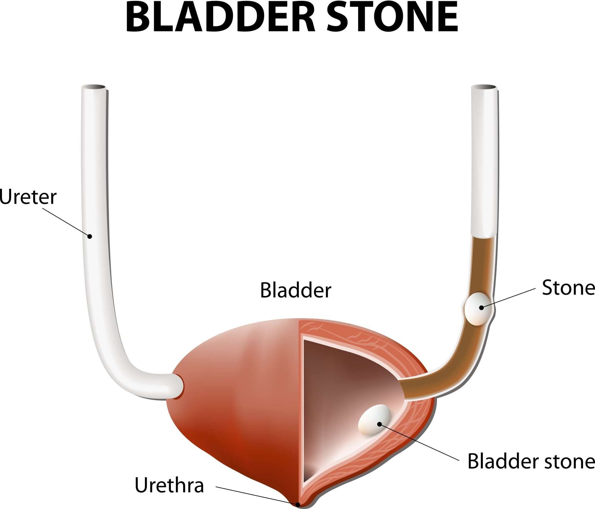 Bladder Stones  Fairbanks Urology