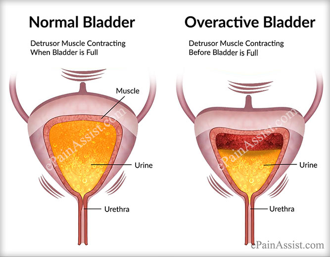 Bladder Training for Women to Prevent Overactive Bladder and Incontinence