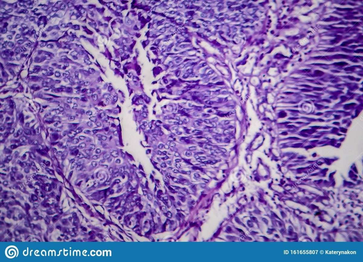 Bladder Transitional Cell Carcinoma, Light Micrograph Stock Image ...