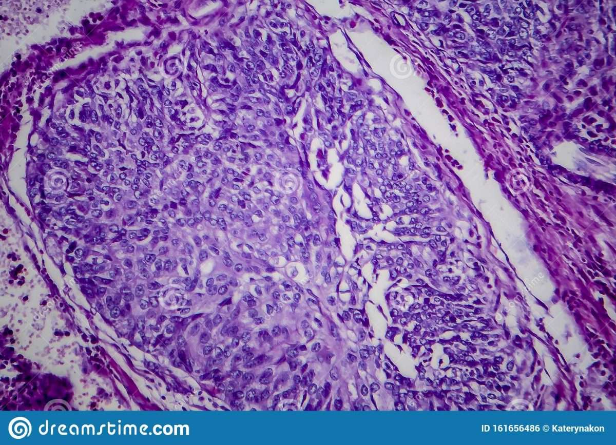 Bladder Transitional Cell Carcinoma, Light Micrograph Stock Photo ...