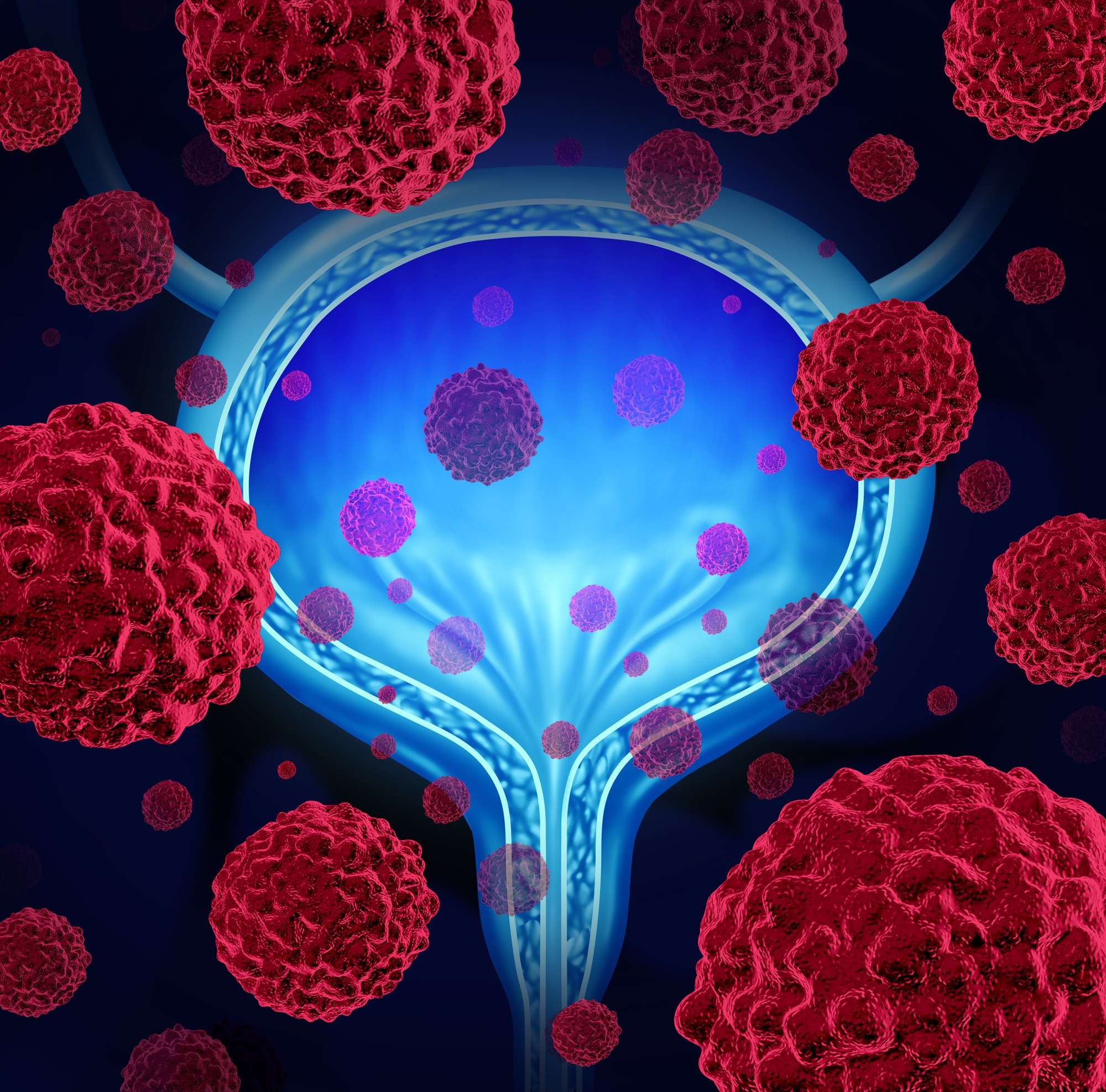 Blue Light Cystoscopy Increases Bladder Cancer Detection Rate