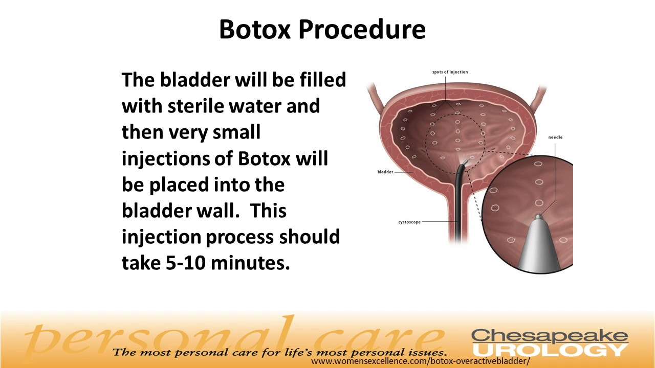 Botox for the Treatment of Overactive Bladder