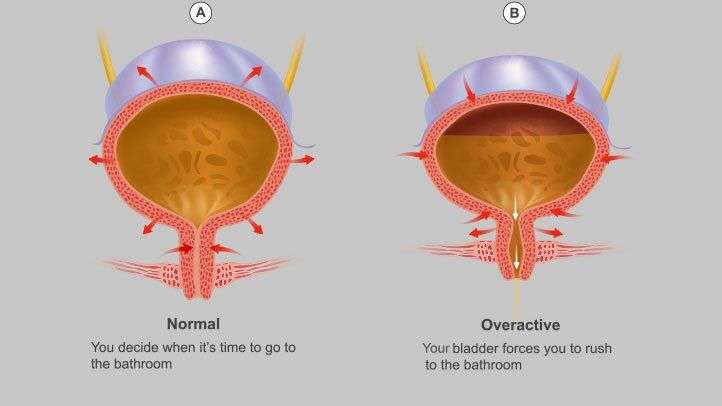 can stress cause overactive bladder