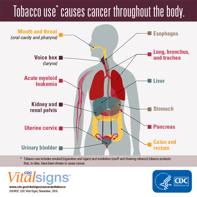 Cancer and Tobacco Use: Tobacco Use Causes Many Cancers ...
