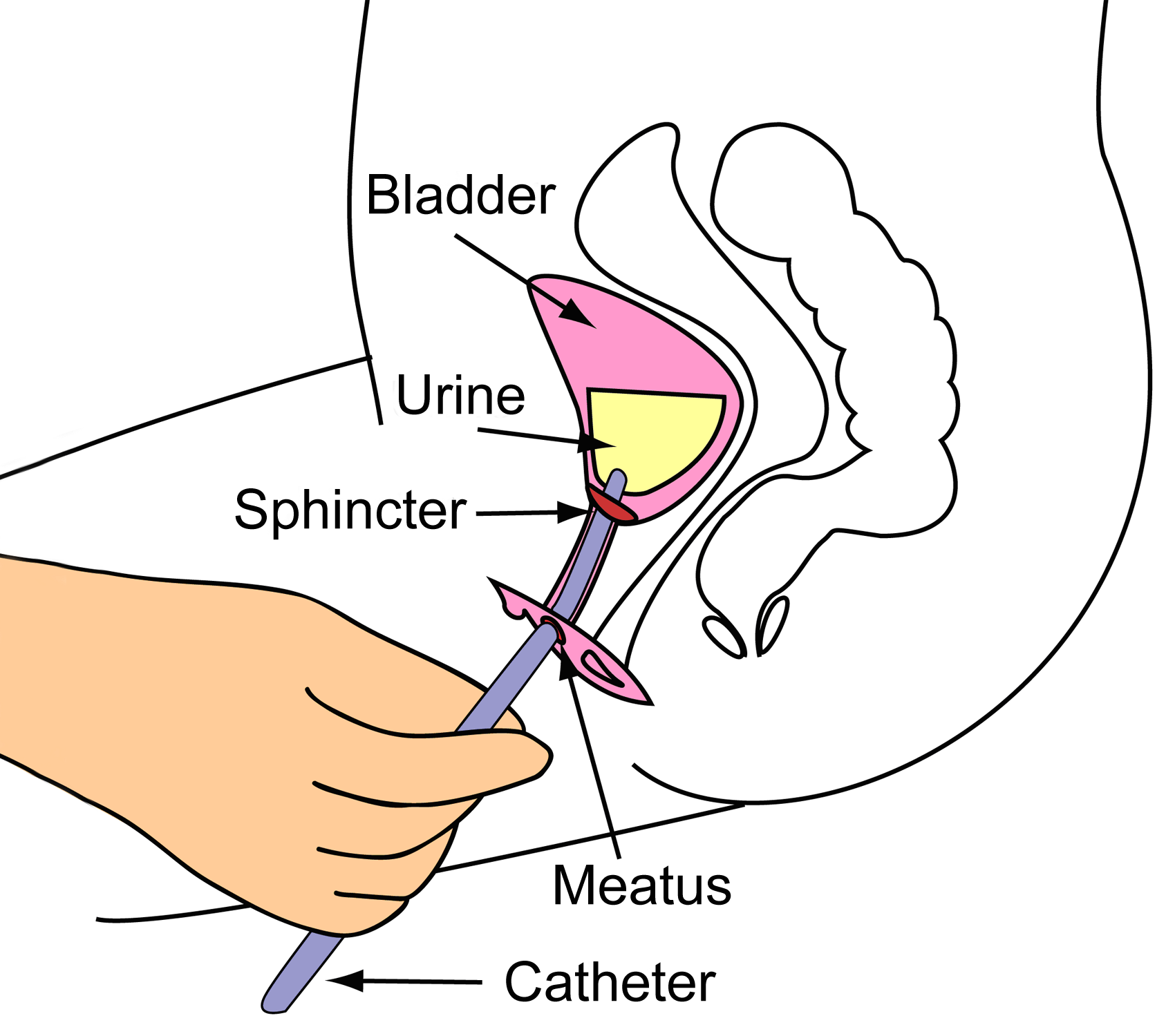 Catheterization Of Female Urinary Bladder
