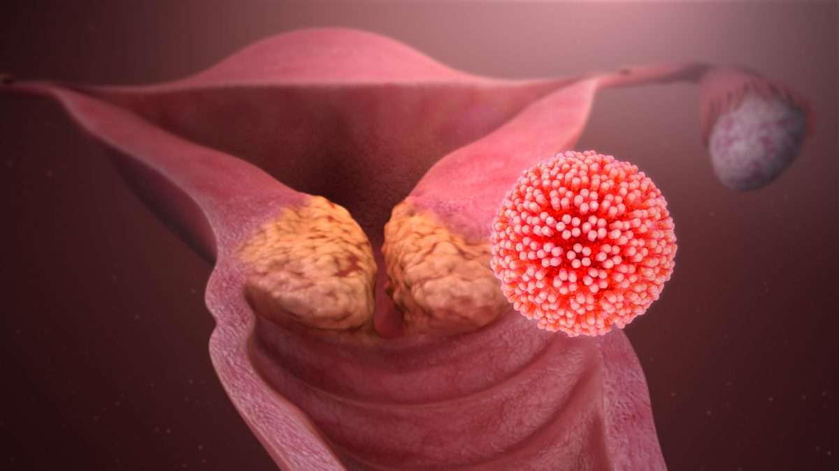 Cervical Cancer Shown and Described Using medical animation still shot