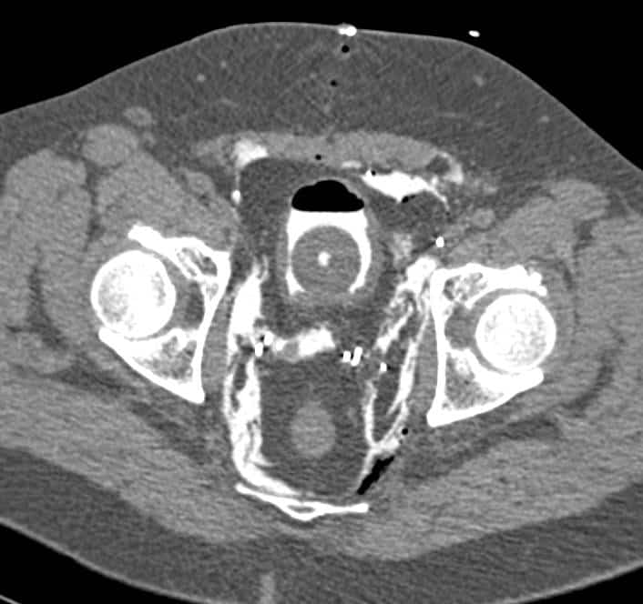 CT Cystogram shows Bladder Contrast Extravasation in Patient s/p ...