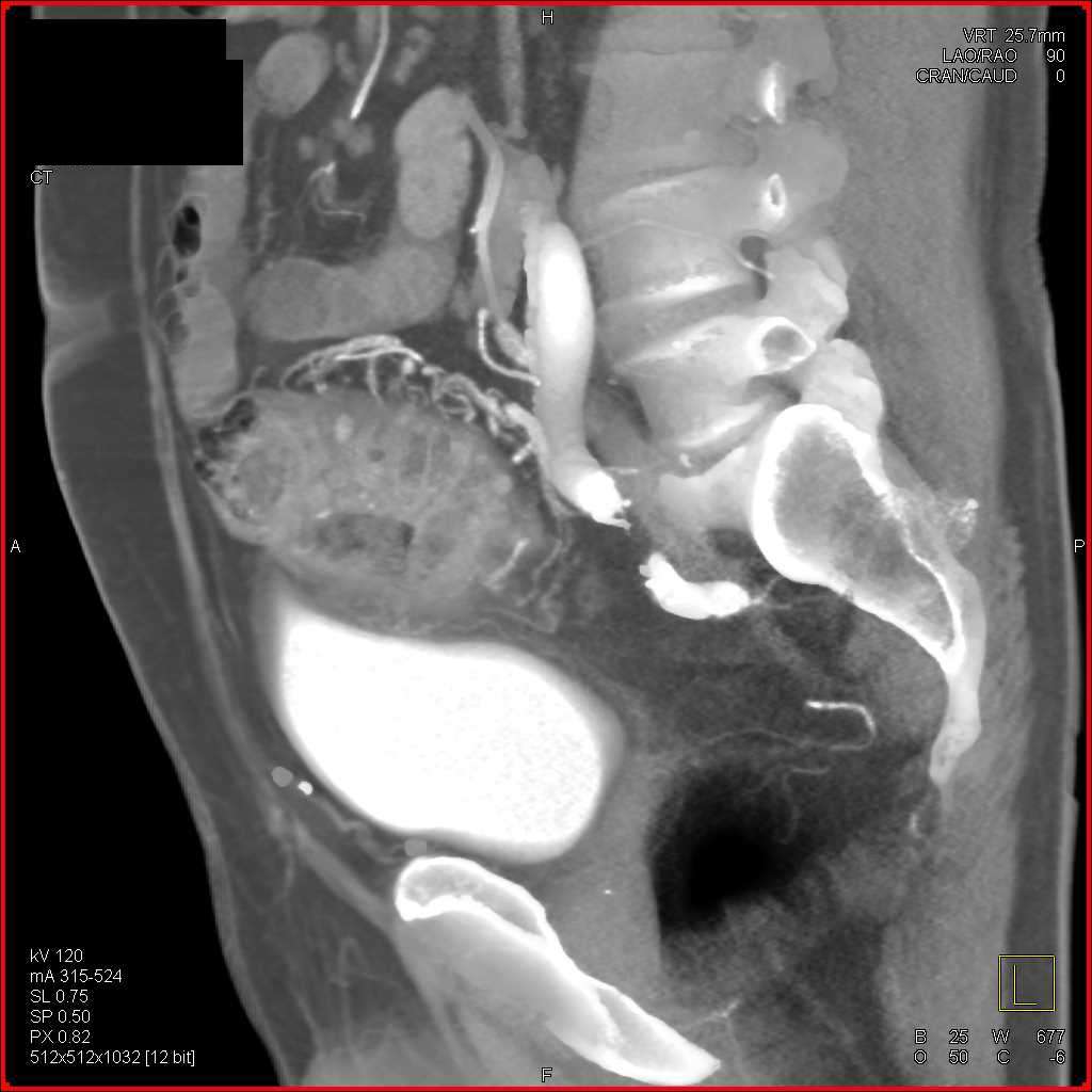 CT Cystogram with Colon Cancer Invading the Bladder